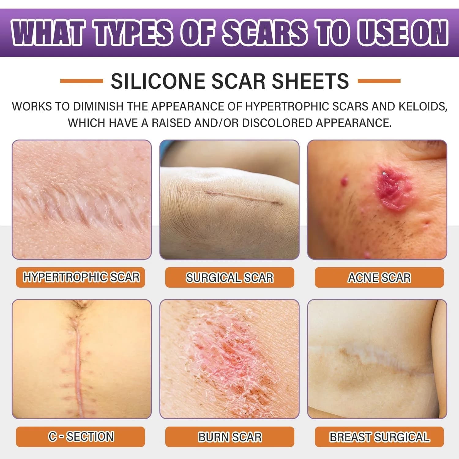 PSECICI Silicone Scar Sheets 1.5m (59") Beige | Medical Grade Scar Tape for Old & New Scars - view 2