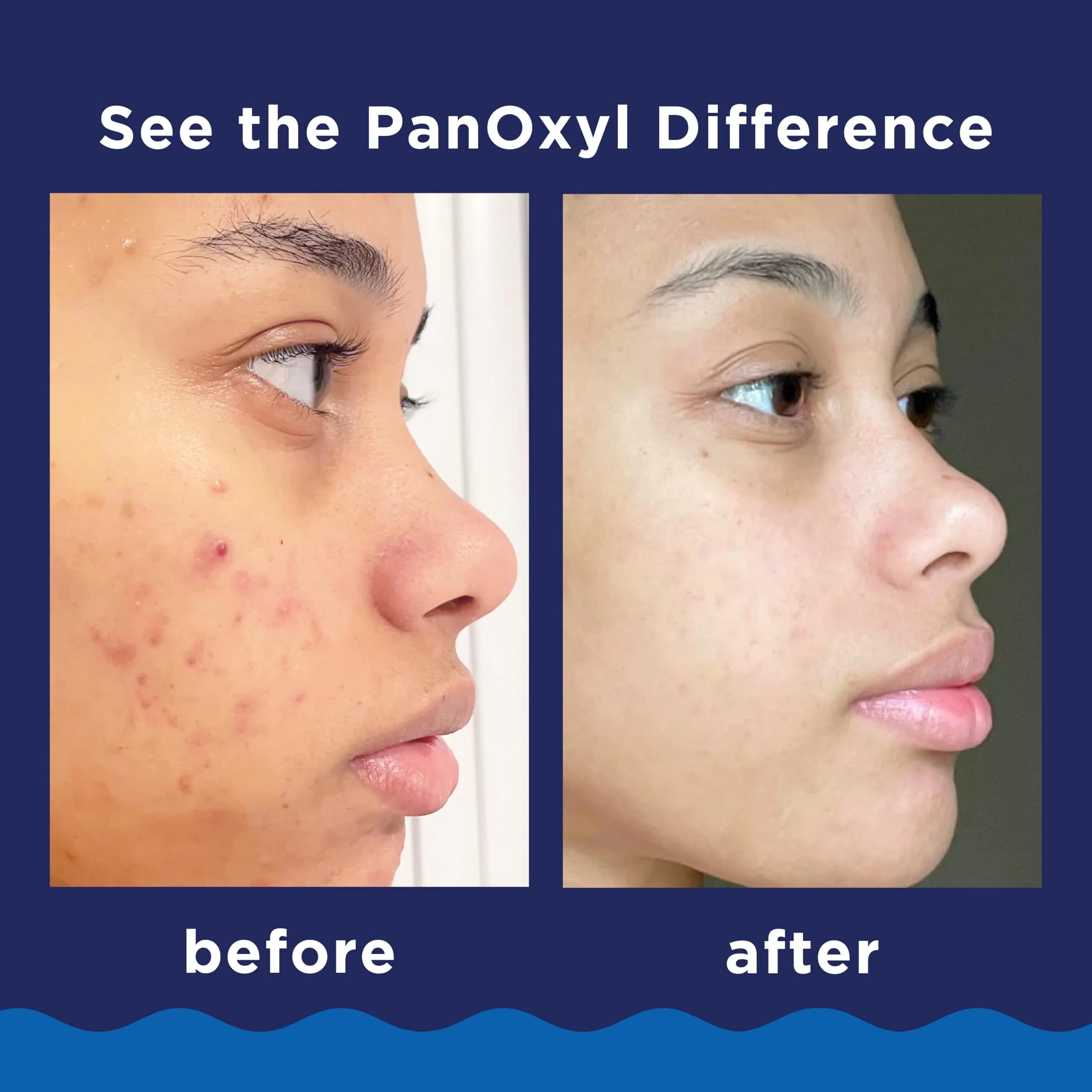 PanOxyl Acne Foaming Wash 10% Benzoyl Peroxide 85g (3 oz) | Kills Acne Bacteria on Contact - view 4