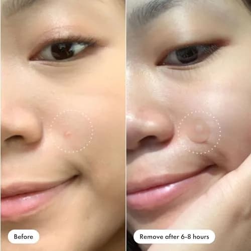 Mighty Patch Original Pimple Patches, 75 Ct | Clinically Tested & Drug-Free Overnight Acne Treatment thumbnail 5