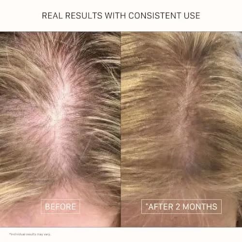 ACTIIV Recover Travel Duo for Women | Fuller Hair in 90 Days (5.4 Fl Oz) thumbnail 6