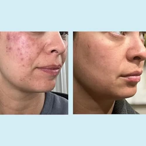 Perfect Image Glycolic Gel Peel 70% Strength for Experienced Users, 1 Fl Oz | High-Concentration Face Exfoliant thumbnail 5
