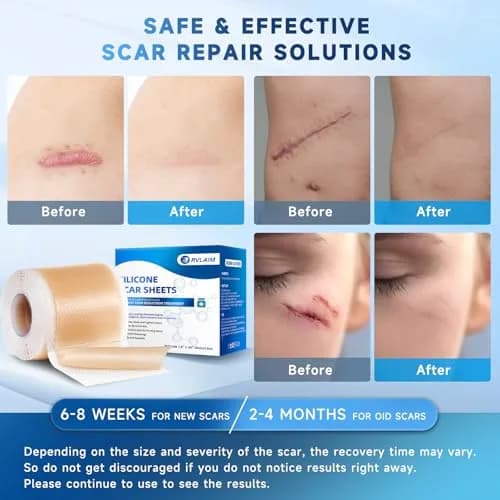 Rvlaim Silicone Scar Sheets, Silicone Scar Tape 1.5M | Clinically Proven Scar Treatment for All Skin Types thumbnail 4