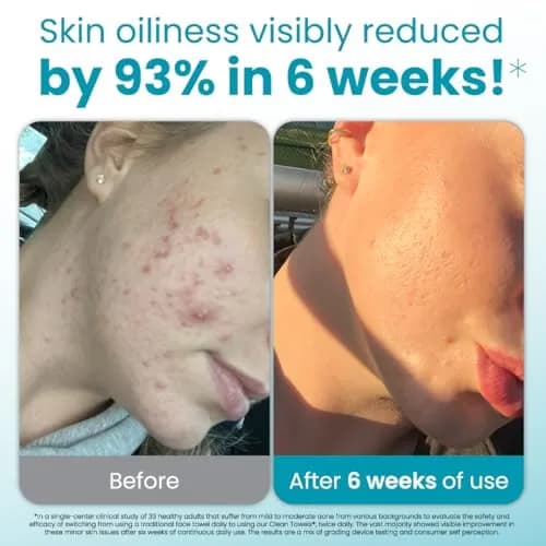 CLEAN SKIN CLUB Blemish Control Clean Towels XL Travel Pack | Exfoliating Face Towels for Oily Skin, Eczema Association Accepted, TSA-Approved (10 Count) thumbnail 2