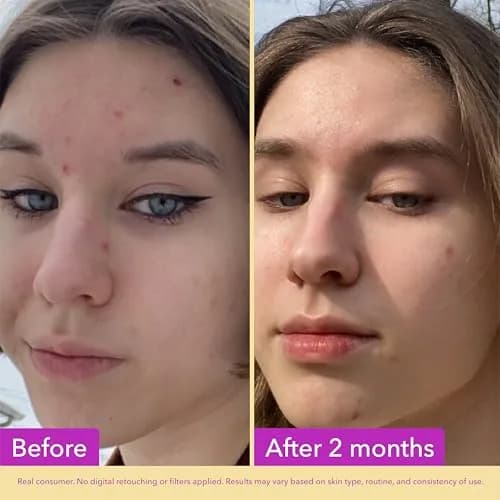 Good Molecules Niacinamide Serum Pack of 2 | 60 ml Total | Targets Blemishes, Uneven Tone & Pores thumbnail 3