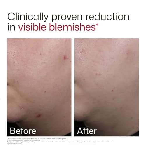 EltaMD UV Clear Blemish-Prone and Oil Balancing SPF 50 Face Sunscreen 50ml (1.7 oz) | Broad Spectrum Protection thumbnail 6