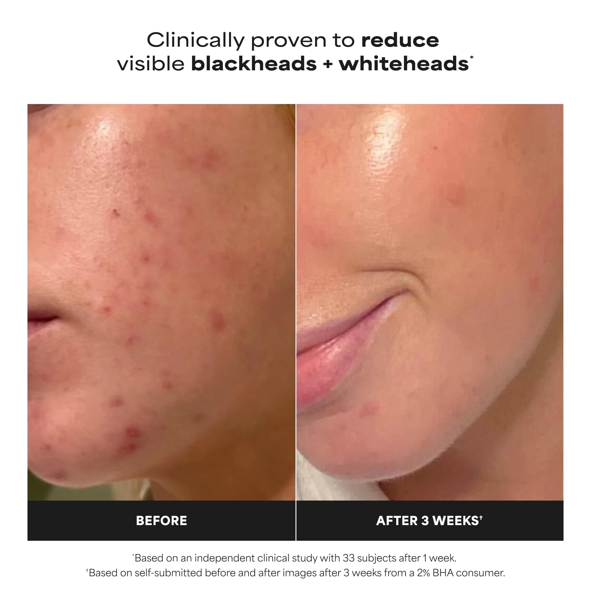 Paula's Choice Skin Perfecting 2% BHA Liquid Exfoliant with Salicylic Acid, 118ml (4 fl oz) | Pores, Wrinkles & Fine Lines - view 3
