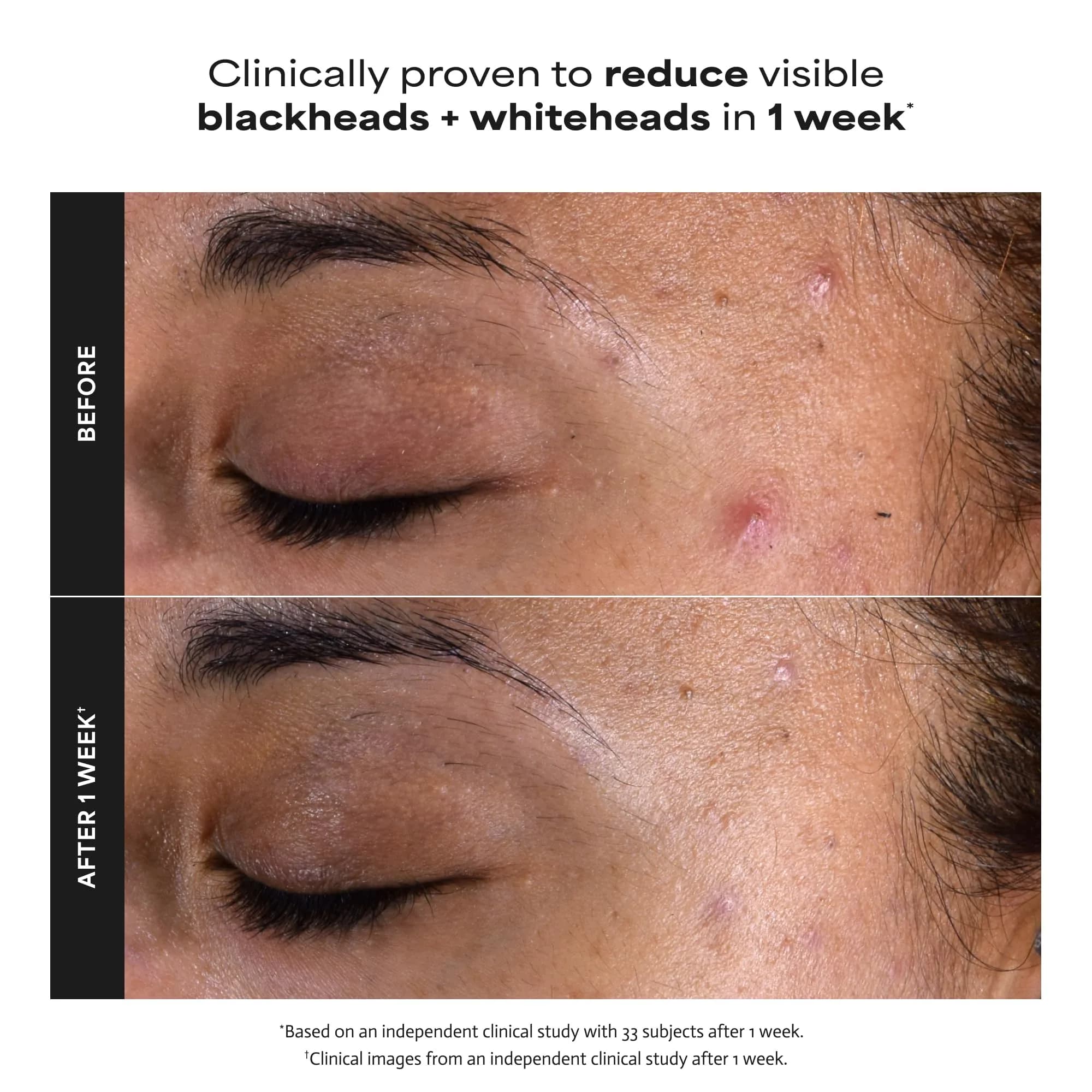 Paula's Choice Skin Perfecting 2% BHA Liquid Exfoliant with Salicylic Acid, 118ml (4 fl oz) | Pores, Wrinkles & Fine Lines - view 5