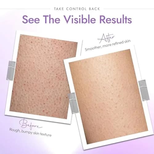 DERMAdoctor KP Bump Eraser Body Scrub 32 oz | 10% AHAs + PHAs for Keratosis Pilaris thumbnail 9