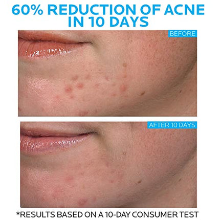 La Roche-Posay Effaclar Duo Dual Action Acne Spot Treatment Cream with Benzoyl Peroxide Acne Treatment for Acne and Blackheads, Lightweight Sheerness, Safe For Sensitive Skin ,0.7 Fl Oz