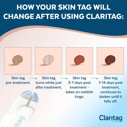 Claritag Advanced Skin Tag Remover, FDA-Cleared Skin Tag Removal in Just 1 Treatment Cycle, Cryogenic Freeze-Off Kit for Mild, Clean and Easy at Home Use, Good for Up to 10 Treatment Cycles
