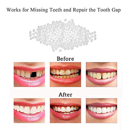 Temporary Tooth Repair Kit-Thermal Beads for Filling Fix The Missing and Broken Tooth or Adhesive The Denture Fake Teeth
